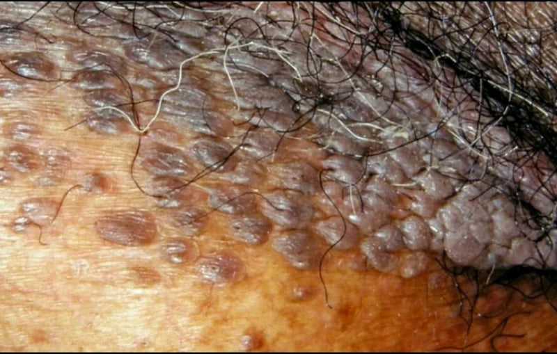Puissant traitement 2 en 1  contre infections